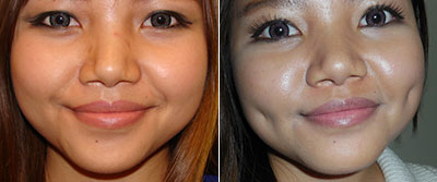 Best Mole Removal treatment clinic in Lucknow