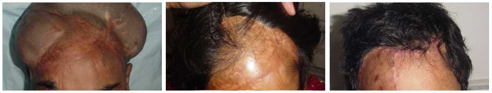 Best Tissue expansion Surgery clinic in Lucknow