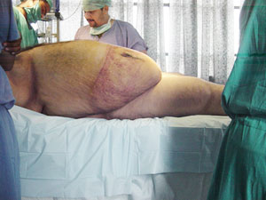 Best Liposuction Doctor in Lucknow