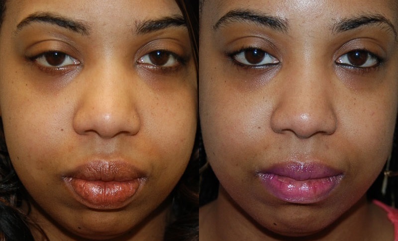 Best LIP surgery clinic in Lucknow