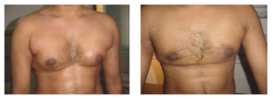 Best Liposuction Doctor in Lucknow