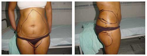 Best Liposuction Doctor in Lucknow