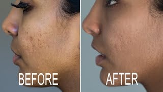 Best Microdermabrasion Surgery Clinic in Lucknow