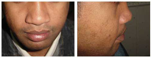 Hand Surgery in Lucknow