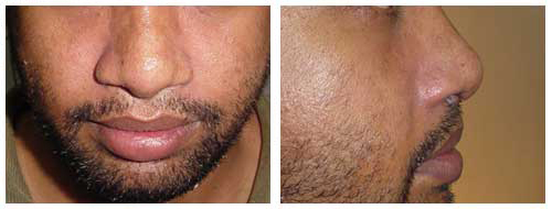 Hand Surgery in Lucknow