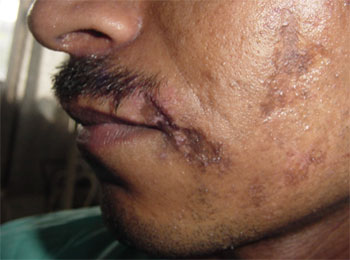 Best Scar Cheek treatment in Lucknow