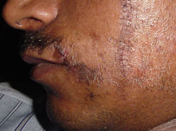 Best Scar Cheek treatment in Lucknow