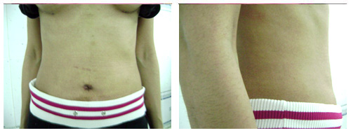 Best Tummy Tuck Surgeon In Lucknow.