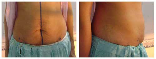Best Tummy Tuck Surgeon In Lucknow.