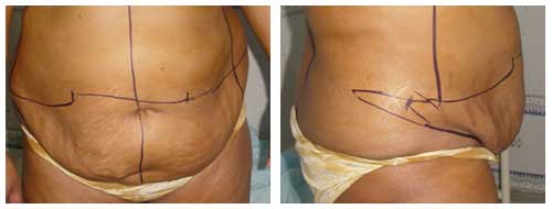 Best Tummy Tuck Surgeon In Lucknow.