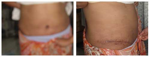 Best Tummy Tuck Surgeon In Lucknow.
