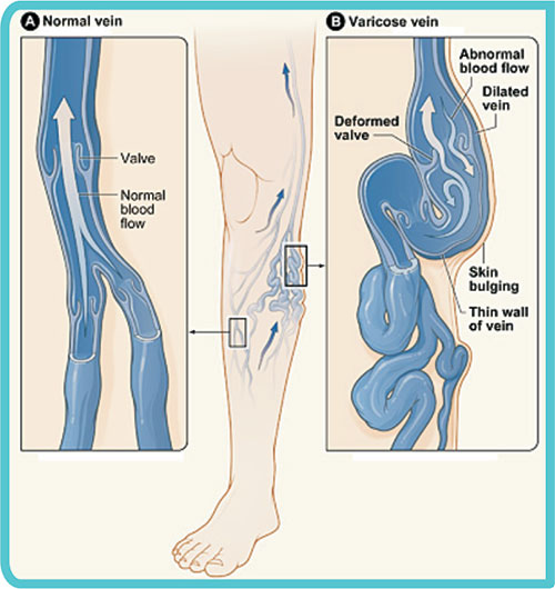 Varicose Veins Laser Treatment Clinic in Lucknow