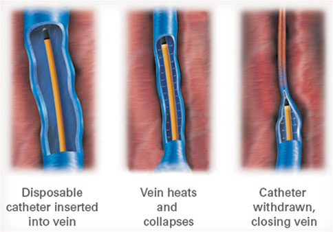 Varicose Veins Laser Treatment Clinic in Lucknow