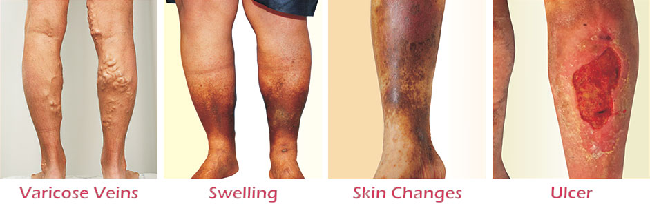 Varicose Veins Laser Treatment Clinic in Lucknow