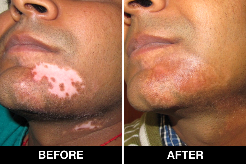 Best White Patch Surgery clinic in Lucknow